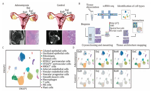 文獻(xiàn)解讀 | 整合單細(xì)胞 RNA 測(cè)序和空間轉(zhuǎn)錄組學(xué)破譯人類子宮腺肌癥的全面轉(zhuǎn)錄圖譜